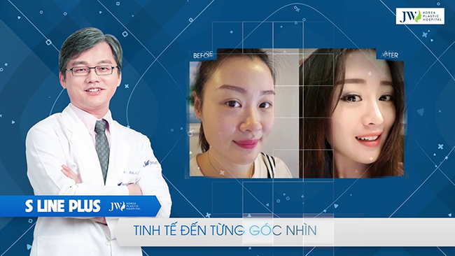 Bác sĩ Hàn Quốc hỗ trợ 100% chi phí cho trường hợp mũi khó